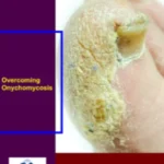 Overcoming Onychomycosis Reviews